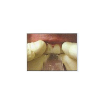 Opalescence PF 20% Teeth Whitening 8pk &amp 3 D.I.Y. Tray Kit