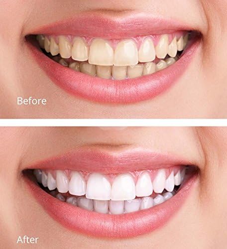 (TM) 44% Carbamide Peroxide 10 (10cc) Syringes of Teeth Whitening Gel - (2) Trays - (1) Shade Guide - (1) Instructions Sheet - at Home Teeth Whitening!