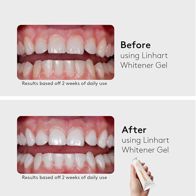 LINHART Teeth Whitening Kit with LED Light - Tooth Whitener Gel Dental Whitening Gel Syringes with 35% Carbamide Peroxide and 16-Led Whitening Light - No Sensitivity Whitens Teeth
