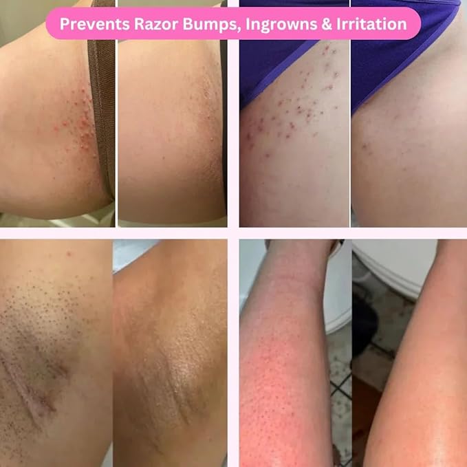 Smoothshave 2.0 Ultimate Women's Razor for Sensitive Skin ? Prevent Ingrown Hairs Razor Bumps &amp Irritation ? Smooth Shave No Nicks or Cuts ? Wet/Dry Use ? Reusable