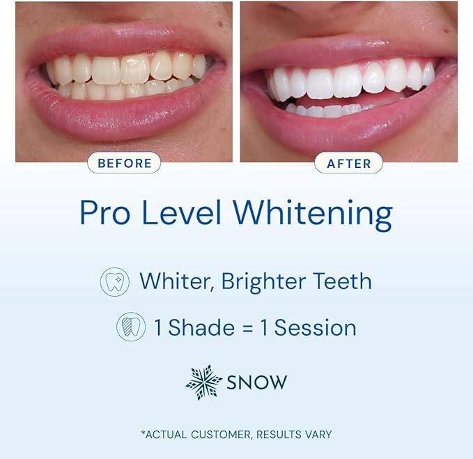 Snow Teeth Whitening Kit - Snow Teeth Whitening Serum and LED Mouthpiece Whitener Formulated with Hydroxyapatite Good for 6 Months - Wireless Kit with 3 Wands