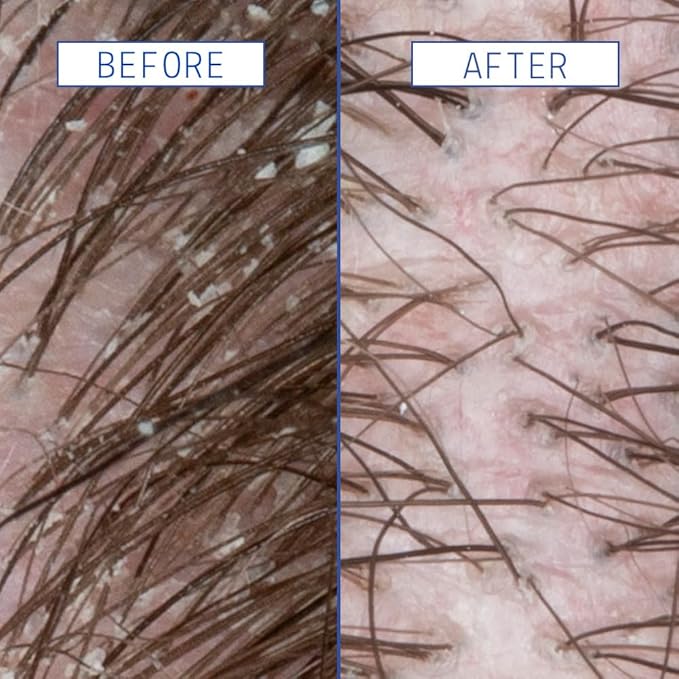 AAVRANI Scalp Rescue Serum - Salicylic Acid Treatment For Dandruff Itchiness &amp Scalp Build Up - With Oatmeal &amp Neem to Soothe - Vegan - 2 Fl Oz