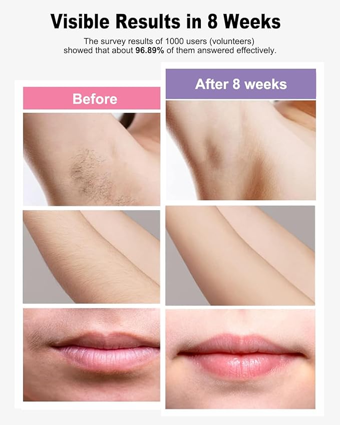 IPL Laser Hair Removal Device Permanent for Women &amp Men 999999 Flashes Safe Effective Lasting Hair Remover Alternative to Salon for Face Arms Armpit Legs Bikini Area Whole Body Home Treatment