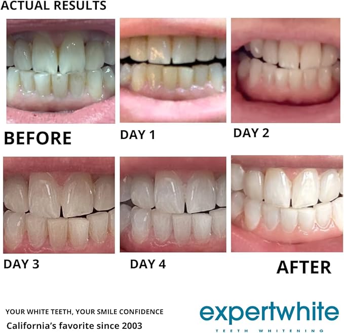 22% Pro Teeth Whitening Gel Refills Carbamide Peroxide Professional Dental-Grade for Trays - Made in USA. Per?xido de carbamida whitening Gel Retainer whitening Gel