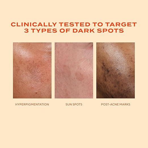 Murad Rapid Dark Spot Correcting Serum - Advanced Anti-Aging Formula with Patented Resorcinol Technology Tranexamic and Glycolic Acids for Hyperpigmentation Dark Spots and Dull Skin - 1 Fl Oz