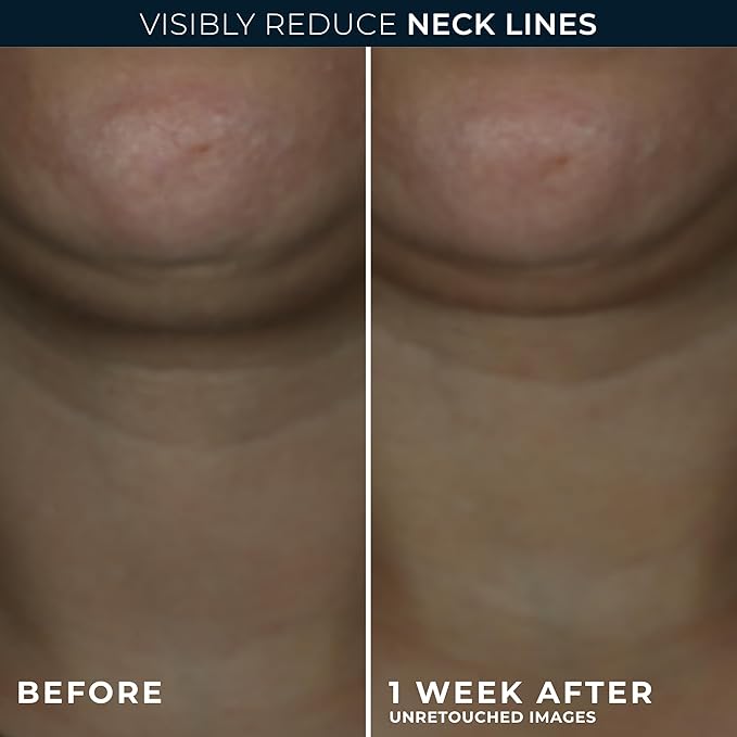 RoC Derm Correxion Neck Cream with Hyaluronic Acid + Advanced Retinol to visibly Tighten &amp Lift Horizontal Neck Lines Facial Moisturizer to Contour Face (1.7 oz) with RoC Retinol Eye Packette