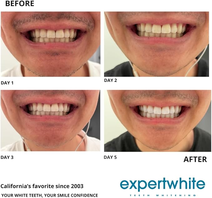 22% Pro Teeth Whitening Gel Refills Carbamide Peroxide Professional Dental-Grade for Trays - Made in USA. Per?xido de carbamida whitening Gel Retainer whitening Gel