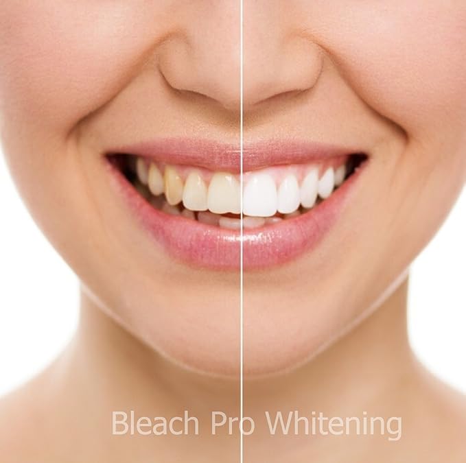 Teeth Whitening Gel Syringe Dispensers 22% Carbamide Peroxide 10 Tooth Bleaching Gel 3ml Syringes