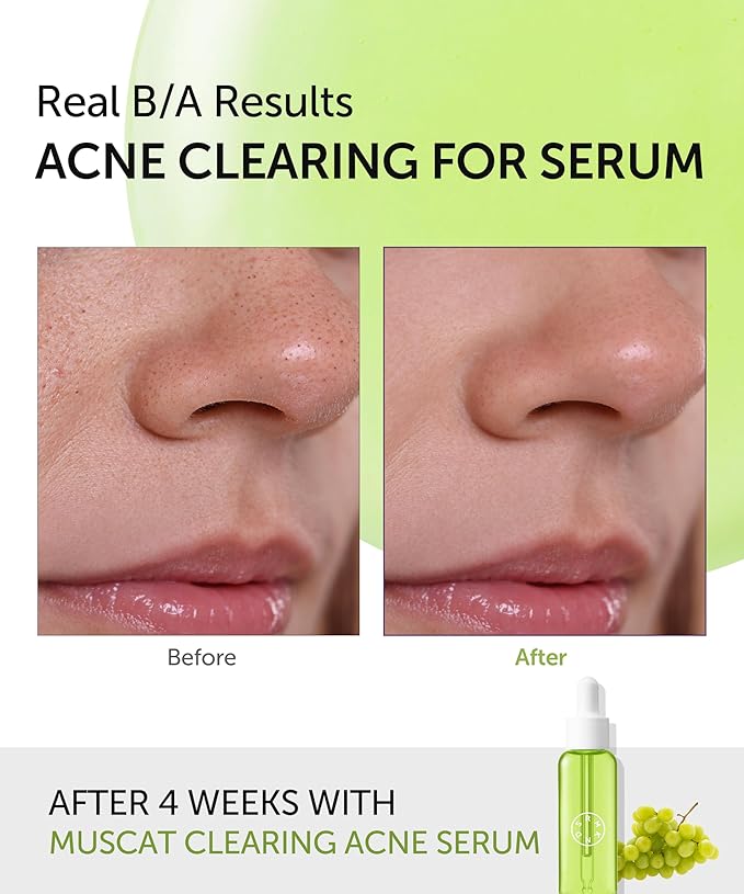 SERUMKIND Muscat Discoloration Correcting facial serum - 1fl oz - Blemishes &amp blackhead remover - Vegan Not Tested on Animals - Korean Skin Care - PHA Redness Relief and Exfoliating