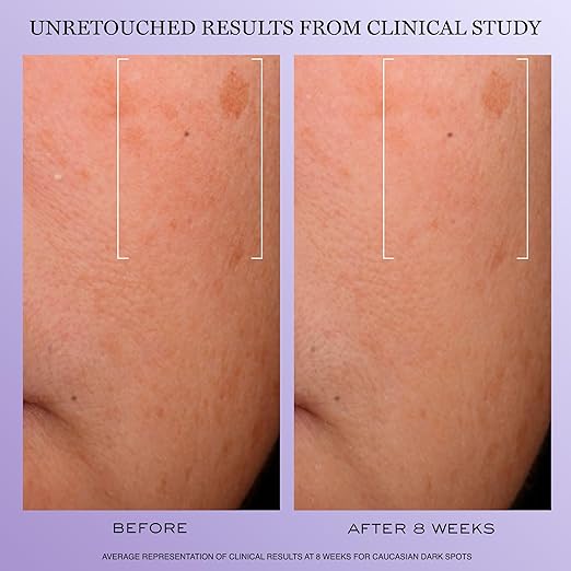 Lanc?me R?nergie H.C.F. Triple Serum - Hyaluronic Acid Serum for Visible Correction of Anti Aging Signs &amp Dark Spots - With Vitamin C+ Niacinamide &amp Ferulic Acid