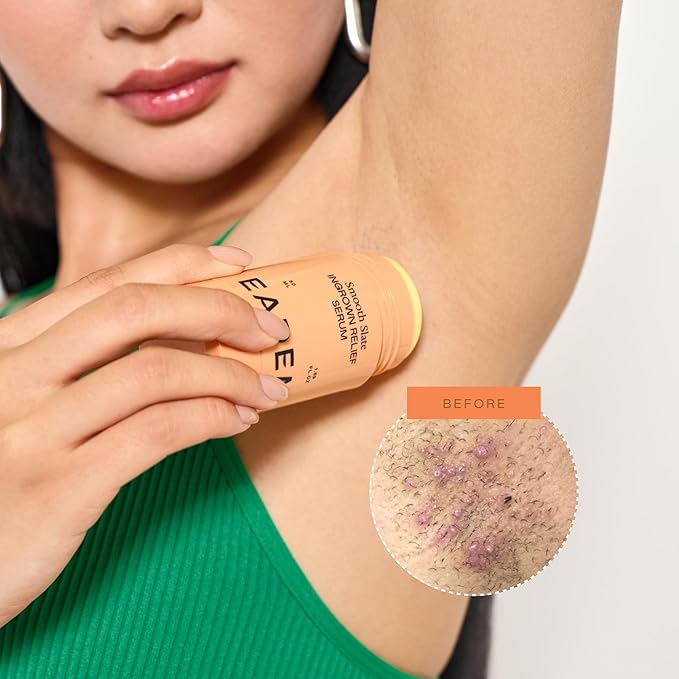 EADEM Smooth Slate Ingrown Hair Roller Serum Targets Bumps Trapped Hairs Faded Topicals for Scarring and Dark Spots AHAs and Tyrosinase Slows Ingrown Hair Regrowth
