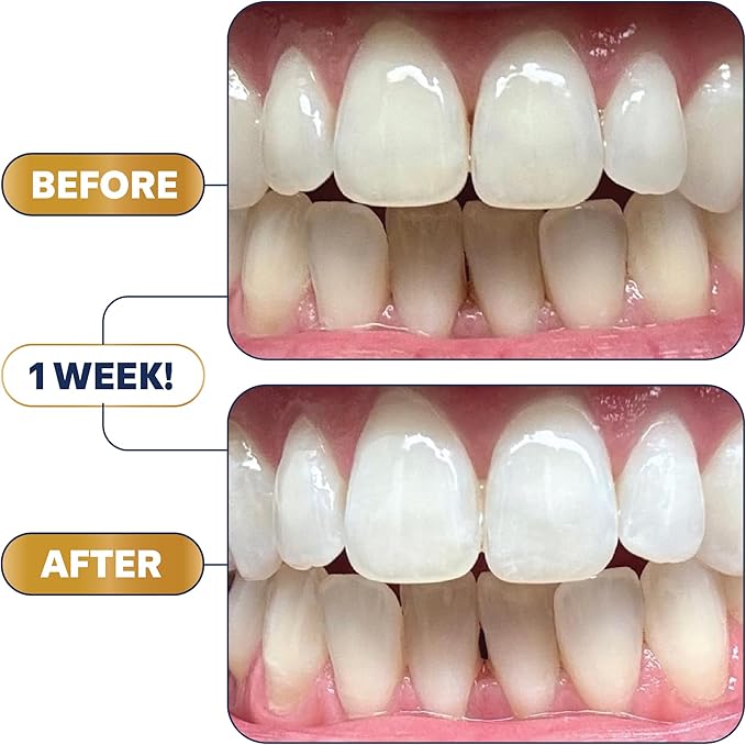 Lumineux Longevity Whitening Kit Bundle - Contains 6X Toothpastes 6X Mouthwashes 2X Strips and 2X Whitening Pens - Enamel Safe and Clinically Proven to Whiten Without The Sensitivity