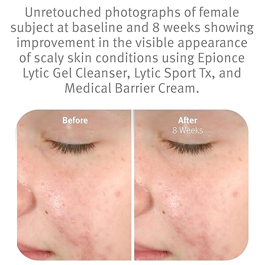 Epionce Lytic Gel Cleanser ? Gentle Foaming Face Wash &amp Makeup Remover | For Oily Combination &amp Problem Skin | Acne &amp Oil-Control Cleanser with Willow Bark | Dermatologist Skincare