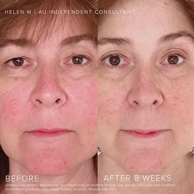 Rodan and Fields Soothe Regimen for Sensitive Irritated Skin and Facial Redness