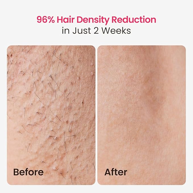 IPL Laser Hair Removal for Women and Men 25J Triple-Pulse Permanent Hair Removal Device for Ingrown &amp Coarse Hair 37°F Painless Sapphire Ice Cooling Hair Removal for Legs Facial Armpits Bikin