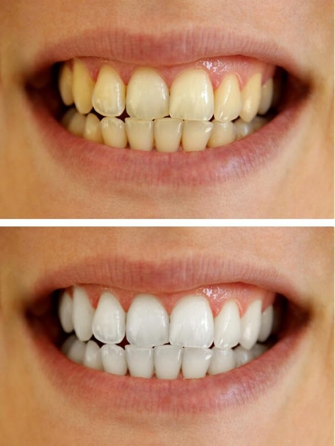 Teeth Whitening Gel Syringe Dispensers 22% Carbamide Peroxide 10 Tooth Bleaching Gel 3ml Syringes