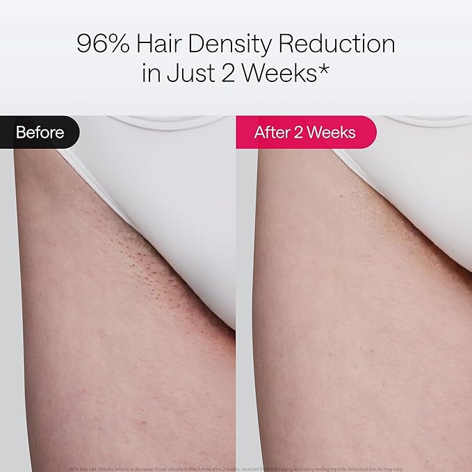 Ulike Laser Hair Removal Device Air 10 Ipl Gift for Women and Men Ice Cool and Permanent Hair Reduction for Nearly Painless Dual Lights Skin Sensor &amp USHR Mode Hair Removal in 10mins from Home