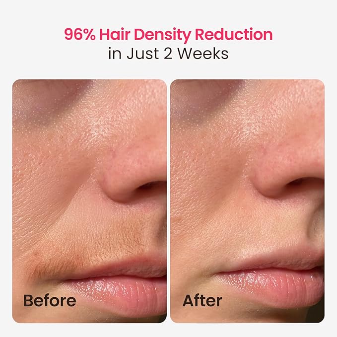 TRIPLE-Pulse IPL Laser Hair Removal 12cm² Sapphire 37°F Ice-Cooling Contact Lazer Hair Removal Device for Women and Men Permanent Hair Removal at Home for Body Face Bikini Trinity iGlow 10