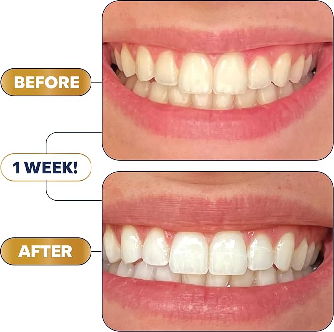 Lumineux Longevity Whitening Kit Bundle - Contains 6X Toothpastes 6X Mouthwashes 2X Strips and 2X Whitening Pens - Enamel Safe and Clinically Proven to Whiten Without The Sensitivity