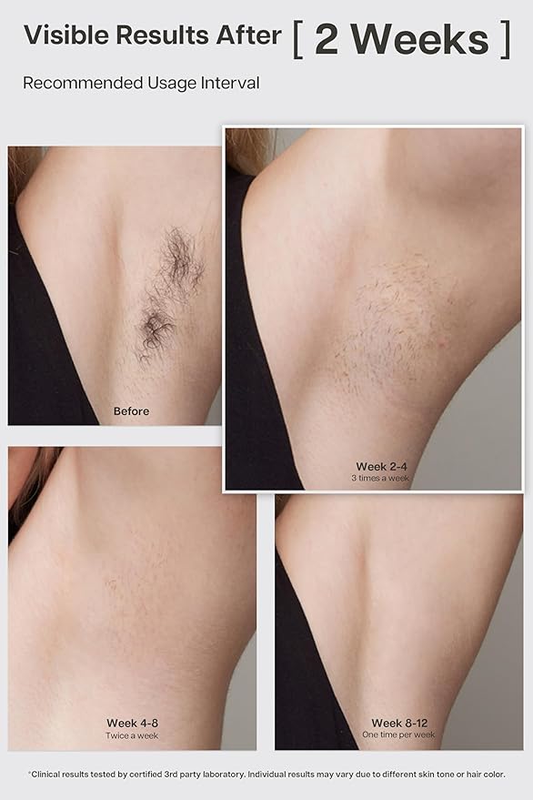 VRAIKO LYRA IPL Hair Removal Device Laser Hair Removal for Women and Men Sapphire Ice-Cooling Contact with Interchangeable Attachment Filters More Skin-Friendly Long-Lasting &amp Painless Results