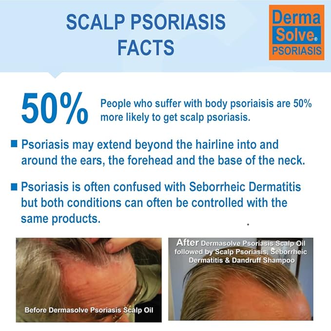 DermaSolve Scalp Psoriasis &amp Dandruff free Medicated Shampoo with Conditioner Ultimate Seborrheic Dermatitis Treatment for Itchy Flakey Scalp Soothing &amp Moisturizing Relief