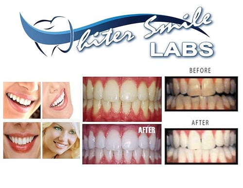 10 XL 38% Teeth Whitening Gel Refill Syringes High Intensity Carbamide Peroxide Gel Whiter Smile Labs Value Pack Teeth Whitener Sold by Dentists