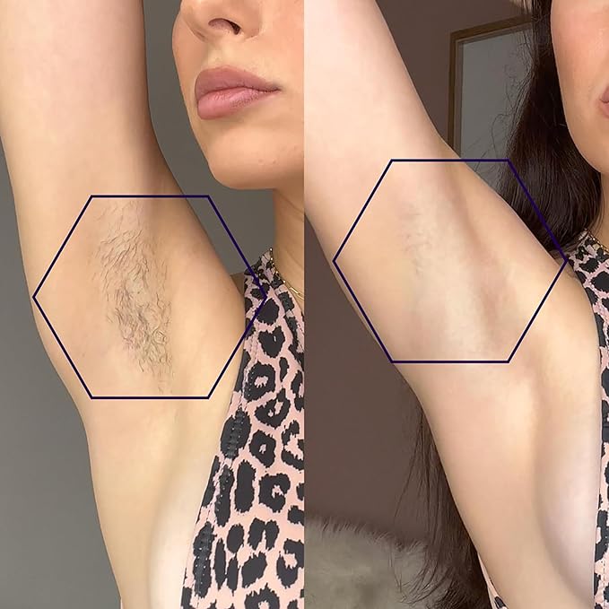 MICHAEL TODD BEAUTY - LUMOS Laser IPL Hair Removal for Women and Men 50°F CoolMax Technology 999999 flashes 3 In 1 w/Skin Sensor for Nearly Painless Permanent hair removal