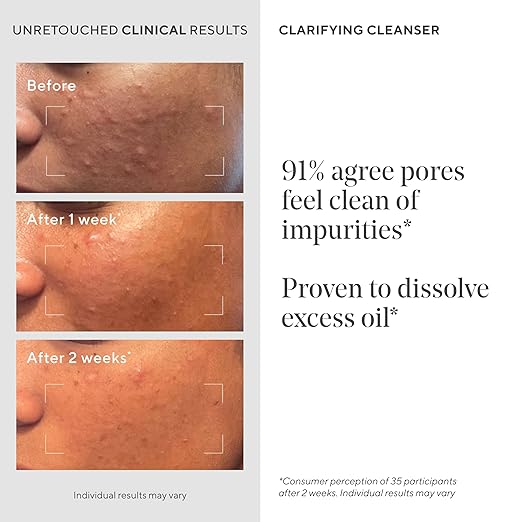 Murad Clarifying Cleanser ? Salicylic Acid &amp Green Tea Formula for Acne Deep Pore Cleansing Oil Control &amp Breakout Prevention for Clear Balanced Healthy-Looking Skin ? 5 Fl Oz