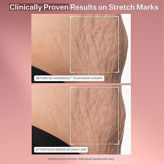 StriVectin SD Advanced Plus Intensive Moisturizer for Wrinkles and Stretchmarks For Face and Body Collagen Boosting with Peptides and Hyaluronic Acid