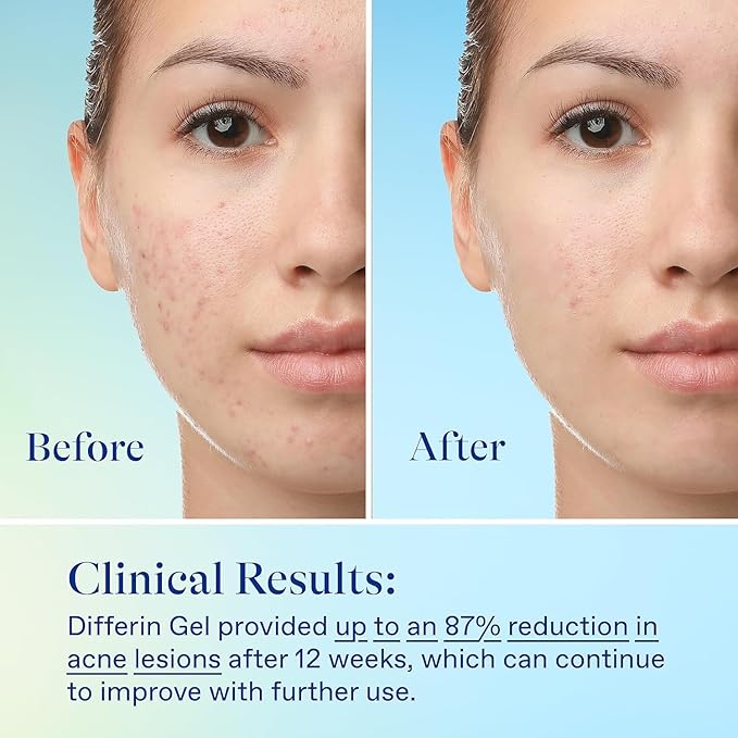 Differin Acne Skin Care Kit Differin Gel Retinoid Acne Treatment for Face with 0.1% Adapalene &amp 5% Benzoyl Peroxide Face Wash &amp Body Wash Designed for Pimple and Acne Prone Skin