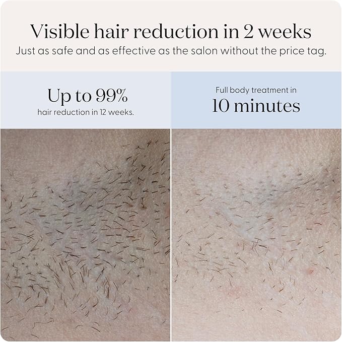 SmoothSkin Pure Fit IPL Hair Removal Device ? At-Home Laser Hair Removal for Women &amp Men Visible Results in 2 Weeks Includes Precision Head Safe for Face &amp Body Long-Lasting Hair Reduction