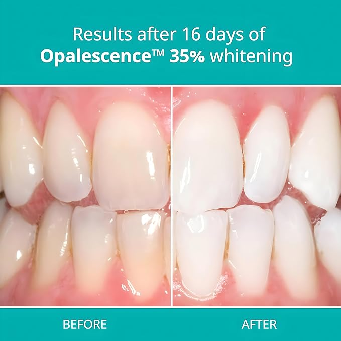 Opalescence 35% with PF Gel Syringes Teeth Whitening Refill Kit - 12 Syringes Carbamide Peroxide Melon Flavor by Ultradent 5404-6