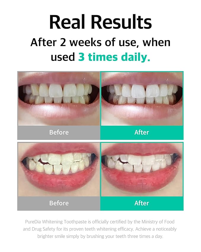 Live Orals Whitening Toothpaste 80g x 5 Units - Fluoride-Free Nano Hydroxyapatite &amp Hydrogen Peroxide Sensitive Teeth Enamel Strengthening Natural Mint Gel