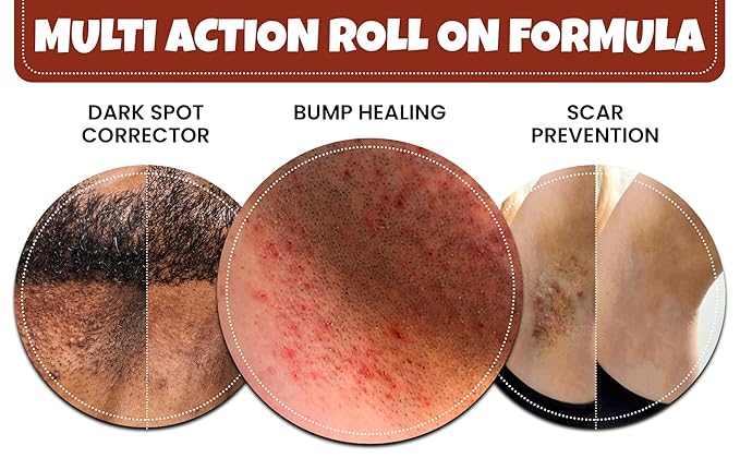 Razor Bumps and Ingrown Hair Treatment Folliculitis Treatment Back Of Head Bumps Remover - Roll On for Men &amp Women