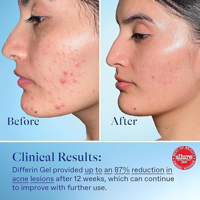 Differin Acne Treatment Gel 90 Day Supply Retinoid Treatment for Face with 0.1% Adapalene Gentle Skin Care for Acne Prone Sensitive Skin 45g Pump (Packaging May Vary)