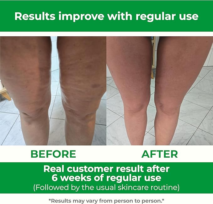 TESMED Cellulite Manual Massager : Made in Italy Patented with Converging &amp Diverging Roller Technology. Anti Cellulite Roller for Thighs and Buttock