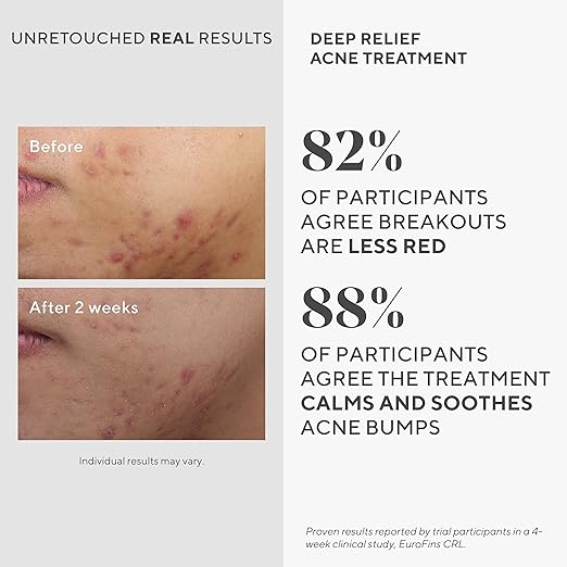 Murad Deep Relief Acne Treatment with 2% Salicylic Acid - Deep Painful Acne Spot Treatment for Face ? Redness Relief Fast Acting Blemish Serum Soothing Breakout Treatment - 1Fl Oz