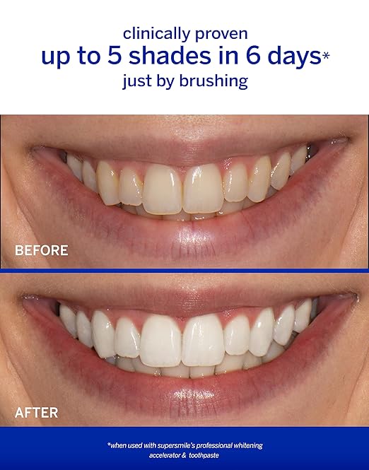 Supersmile Peppy Mint Teeth Whitening Toothpaste Set Complete 5-Piece Travel Set with 3 Toothpastes 1 Accelerator &amp 1 Toothbrush Whitening Toothpaste Kit Whitens up to 6 shades.
