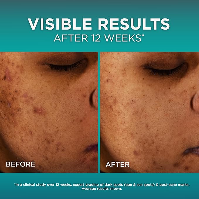 L?™Or?al Paris Bright Reveal 12% [Niacinamide + Amino Sulfonic + Ferulic] Dark Spot Serum 1oz + Moisturizer Sample