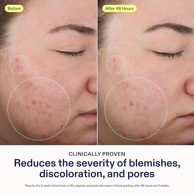 Skinfix 2% BHA Cleanser - 5 oz - Clears Acne Blemishes &amp Blackheads - Safe for All Types of Acne - Fragrance Free - Vegan Cruelty Free