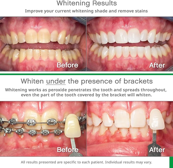 Opalescence Go - Prefilled Gel Teeth Whitening Trays (2 Packs / 20 Treatments) - 15% Hydrogen Peroxide - Teeth Whitening Kit -Mint - 5194-2