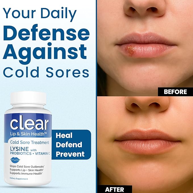 Lysine Cold Sore Treatment for Lips with Pre-Probiotics &amp VIT C | 1 Month Supply | Supercharged Lysine Capsules with Rhamnosus &amp Acidophilus for Cold Sores Relief Skin + Gut Health &amp Immu