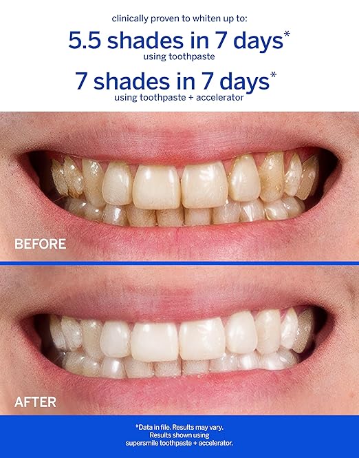 Supersmile Professional Whitening Accelerator - Powerful Whitening without Sensitivity - Safe and Effective on Dental Restorations (3.6 Oz)