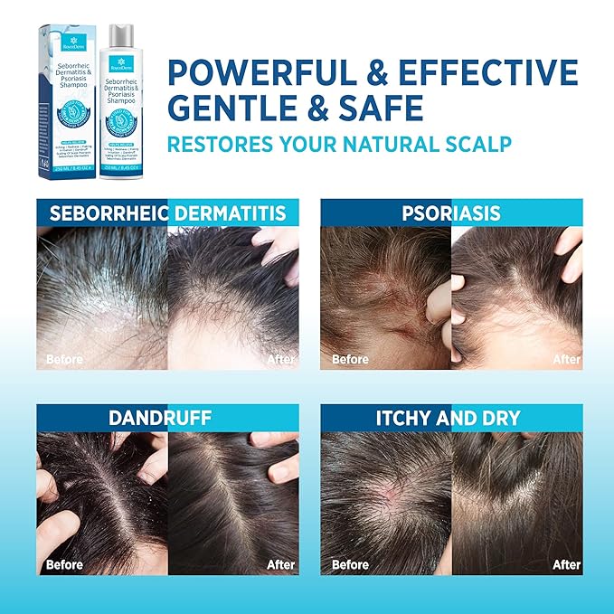 Seborrheic Dermatitis &amp Psoriasis Cream Shampoo and Conditioner Set - Scalp Therapy System for Folliculitis Psoriasis Dandruff Dry Scalp - Scalp Treatment to Relieve Itching Flaking Irritati