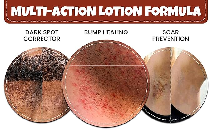 BUMP Terminator Fast Acting Alcohol BASED Water Free Anti Razor Bumps Ingrown Hair Skin Treatment for Face Neck Bikini Area Legs &amp Back Of Head Bumps Remover Unisex Lotion 5.4 fl oz