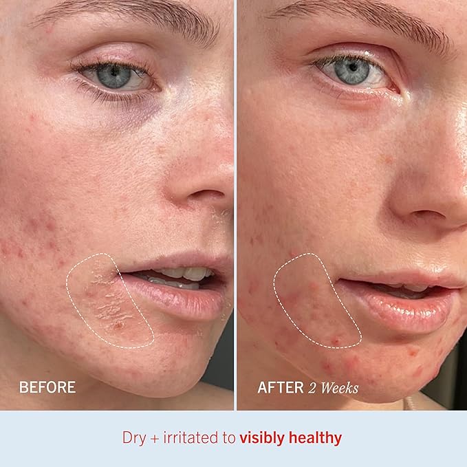 First Aid Beauty - Ultra Repair Cream Intense Hydration Whipped Colloidal Oatmeal Clinically Proven to Strengthen Skin Barrier in 7 Days + Helps Relieve Eczema Luxury Moisturizer (6oz 2ct)