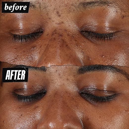 Kiehl's Clearly Corrective Dark Spot Serum Brightening Facial Serum Reduces Hyperpigmentation &amp Post-acne Marks with Vitamin C &amp Salicylic Acid All Skin Types Paraben-free Mineral Oil-fr