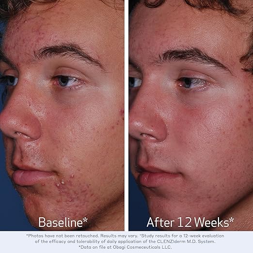 Obagi CLENZIderm M.D. Daily Care Foaming Acne Cleanser ? Acne Treatment with 2% Salicylic Acid (BHA)