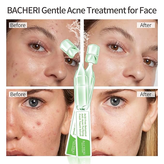 Gentle Botanical Acne Treatment for Face ? Acid-Free Spot Facial Serum with Niacinamide &amp Witch Hazel Soothes Redness &amp Controls Breakouts for Sensitive Oily &amp Acne-Prone Skin ? 1.2 ml ×
