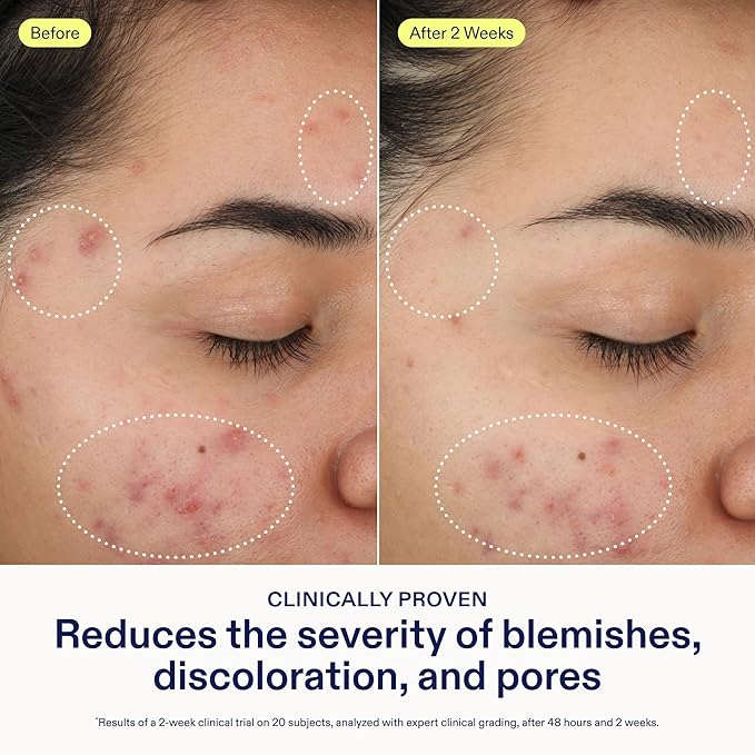 Skinfix 2% BHA Cleanser - 5 oz - Clears Acne Blemishes &amp Blackheads - Safe for All Types of Acne - Fragrance Free - Vegan Cruelty Free